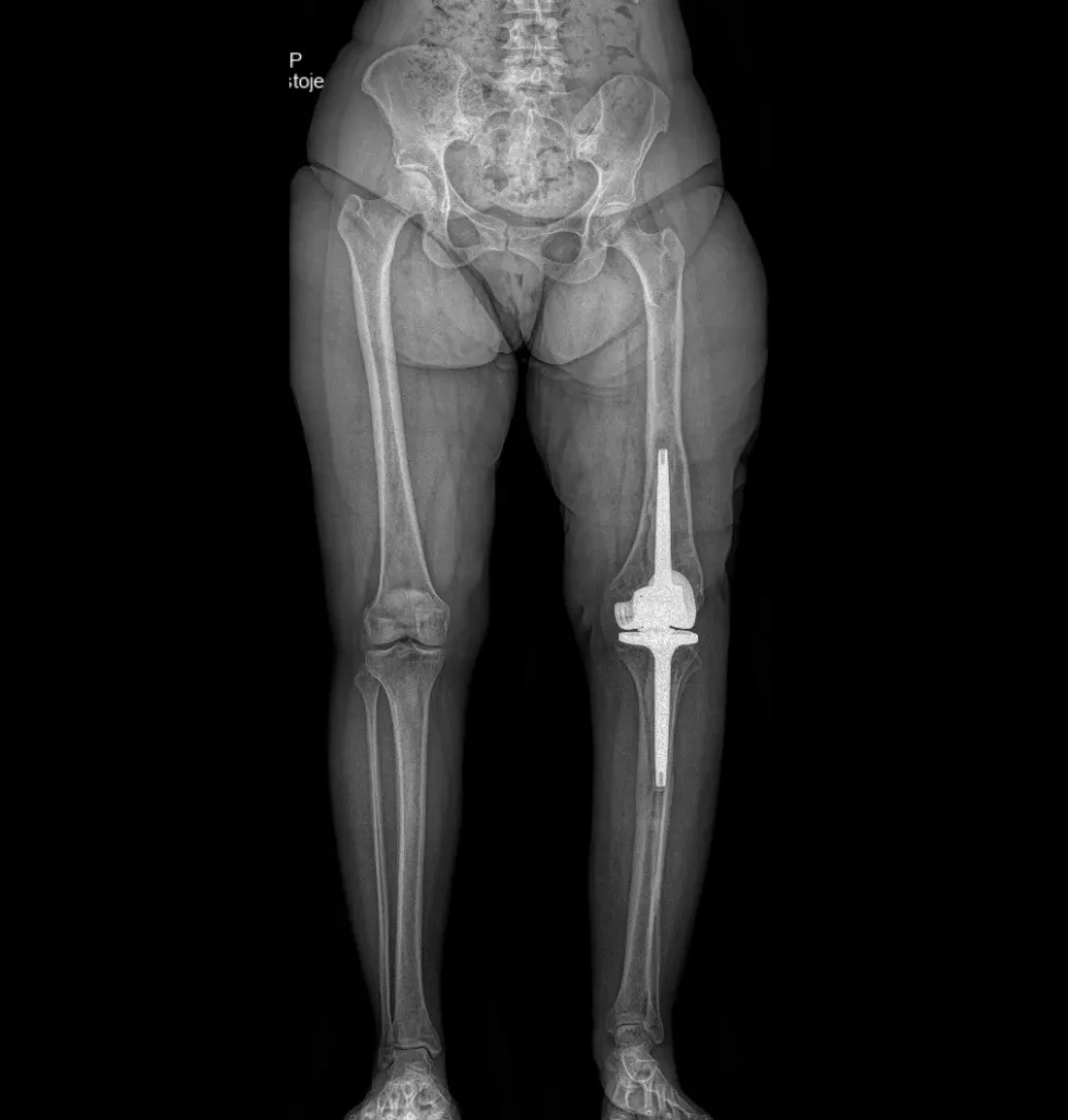 RTG dolních končetin po operaci