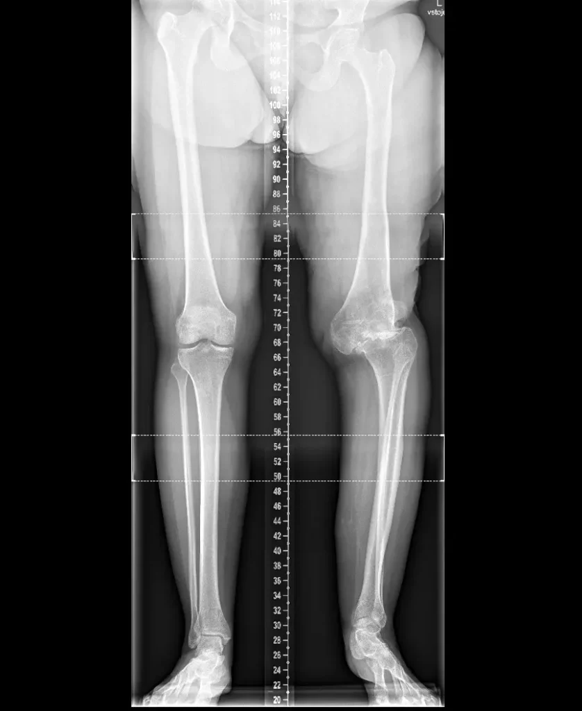 RTG dolních končetin před operaci