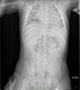 rtg snímek po polknutí plíšku