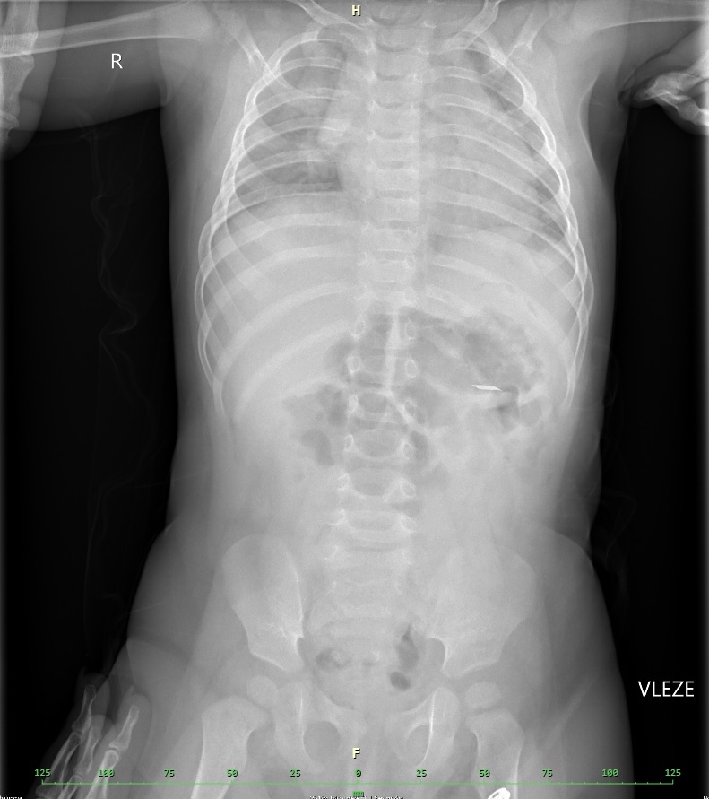 rtg snímek po polknutí plíšku