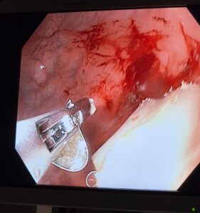 endoskopické odstranění